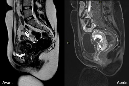 Approche innovante: la cryoablation dans le traitement de pathologies gynécologiques