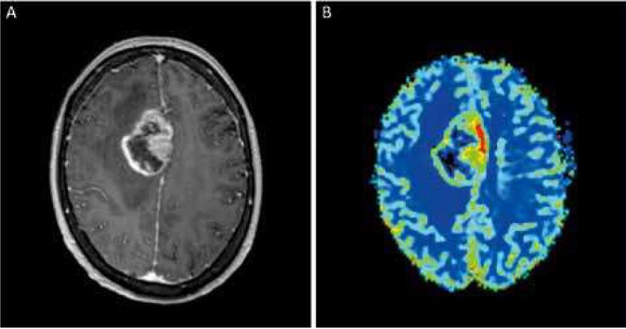 L’imagerie moderne au service des patients atteints d’une tumeur cérébrale