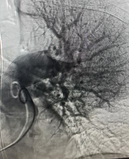 Première en Wallonie: traitement percutané d’embolie pulmonaire massive