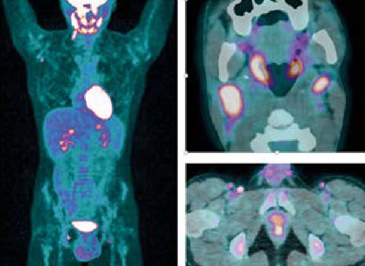 Adénopathies cervicales: une maladie à ne pas oublier dans le diagnostic différentiel