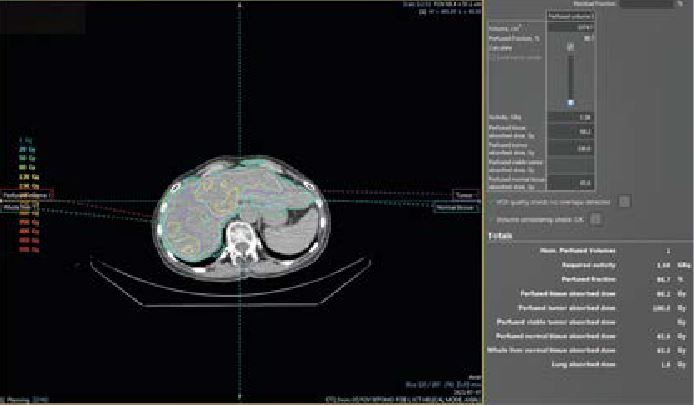 La dosimétrie personnalisée en radiothérapie interne sélective