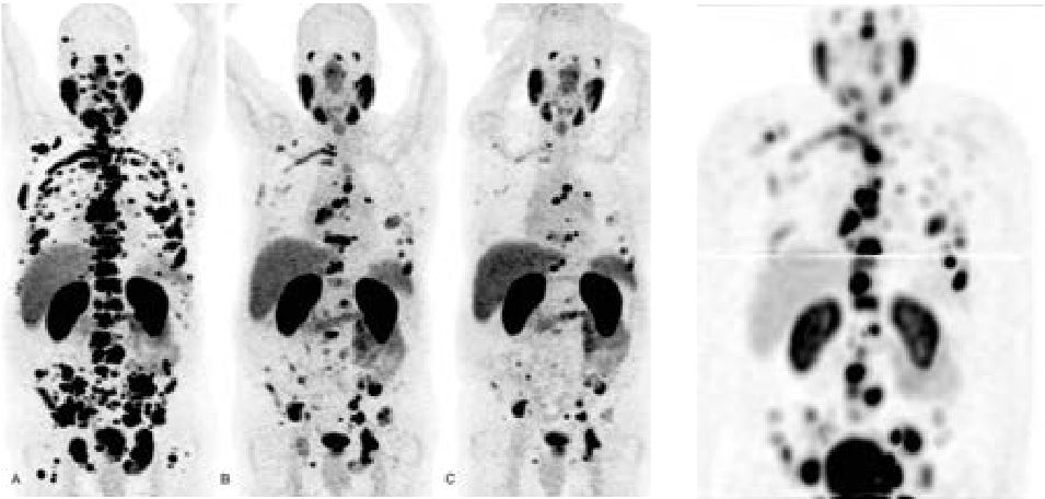 Thérapies métaboliques. Focus sur le lutetium177-PSMA