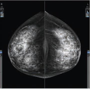 Angiomammographie: une technique diagnostique optimisée pour la détection du cancer du sein